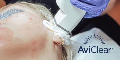 AviClear Laser เลเซอร์ที่ออกแบบมาเพื่อรักษาสิวโดยเฉพาะ