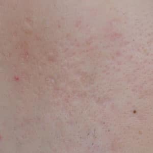หลุมสิวแบบ Box Scars หรือ หลุมสิวแบบกล่อง