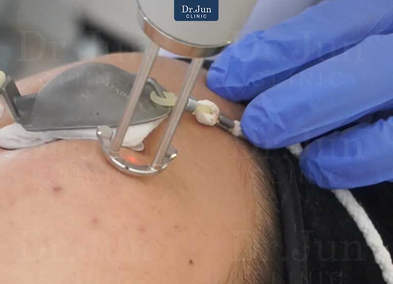 Discovery Pico Derm เลเซอร์คุณภาพสูงสลายเม็ดสี