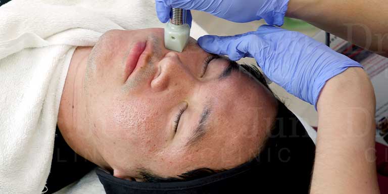 การรักษาหลุมสิวด้วย Fractora