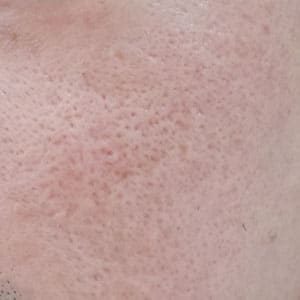 หลุมสิวแบบ Ice Pick Scars หรือ หลุมสิวแบบจิก