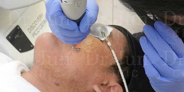 การรักษาหลุมสิวด้วย Discovery Pico Derm
