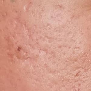 หลุมสิวแบบ Rolling Scars