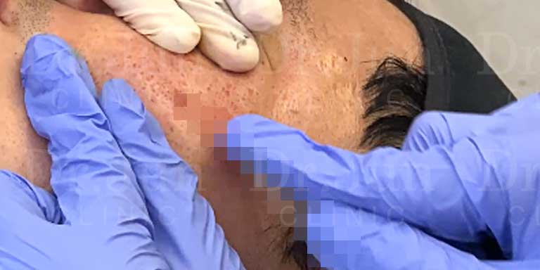 การรักษาหลุมสิวด้วยการทำ Subcision