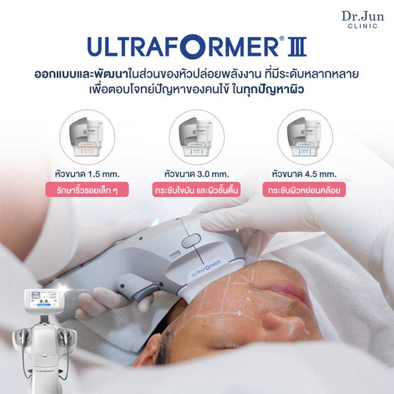 Ultraformer III ยกกระชับผิว แบบไม่ต้องผ่าตัด