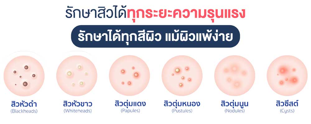 AviClear-Laser-ประเภทของสิวอักเสบ