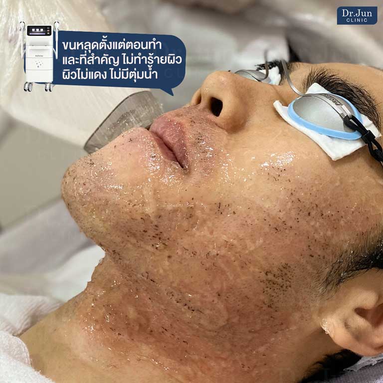 MeDioStar Monolith กำจัดขนลงลึกถึงราก ลดการเกิดใหม่ของเส้นขน