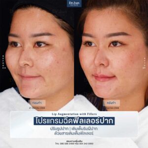 โปรแกรมฉีดฟิลเลอร์ปาก